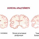 Alzheimer&#39;s Brain.jpg