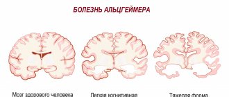 Мозг Альцгеймер.jpg